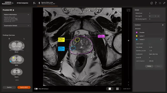 Screenshot Siemens AI-Rad Companion